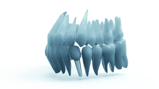 **Druk 4D implantów: Czy personalizacja jest warta swojej ceny? Analiza kosztów i korzyści.**